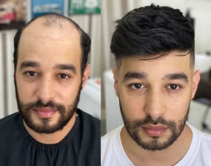 Resultado — linha frontal de implantação