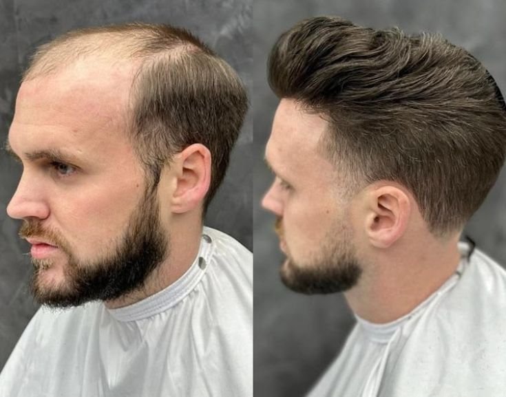 Resultado — vista de perfil, densidade